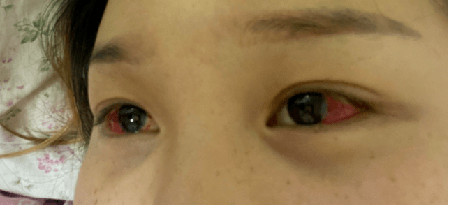 眼球發(fā)紅充血的原因及應(yīng)對措施，眼球發(fā)紅充血，原因解析與應(yīng)對策略