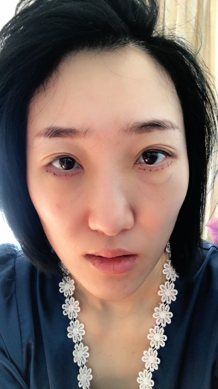 眼袋外切手術(shù)后的恢復(fù)之旅，第15天的變化與照片分享，眼袋外切手術(shù)恢復(fù)之旅第15天，變化與照片分享