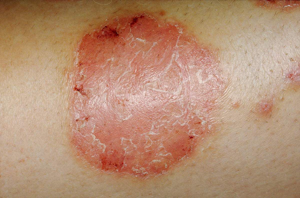 皮膚病圖片大全，深入了解與識別各種皮膚病癥狀，皮膚病癥狀全面解析，皮膚病圖片大全及識別指南