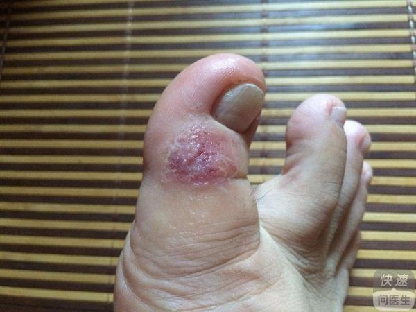 水泡型腳氣，成因、癥狀、治療與預(yù)防策略，水泡型腳氣詳解，成因、癥狀、治療方法及預(yù)防策略