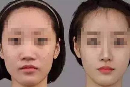 鼻子整形有哪幾種方法及其特點(diǎn)，鼻子整形的多種方法及特點(diǎn)解析