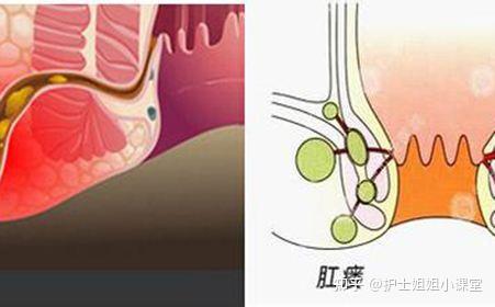 肛瘺的癥狀表現(xiàn)及其影響，深入了解肛瘺，肛瘺的癥狀表現(xiàn)與影響，全面深入了解肛瘺