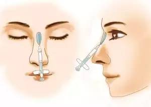 玻尿酸鼻子的美麗之旅，圖片解析與指南，玻尿酸鼻子塑形之旅，圖片詳解與美麗指南