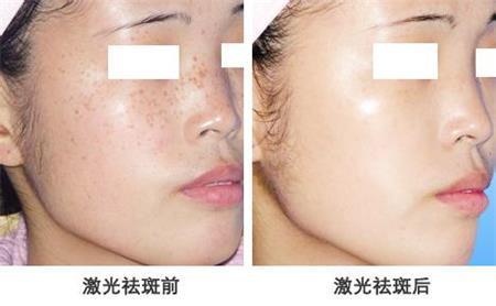 激光祛斑，真的有效嗎？全面解析激光祛斑效果及其影響因素，激光祛斑真的有效嗎？深度解析效果與影響因素！