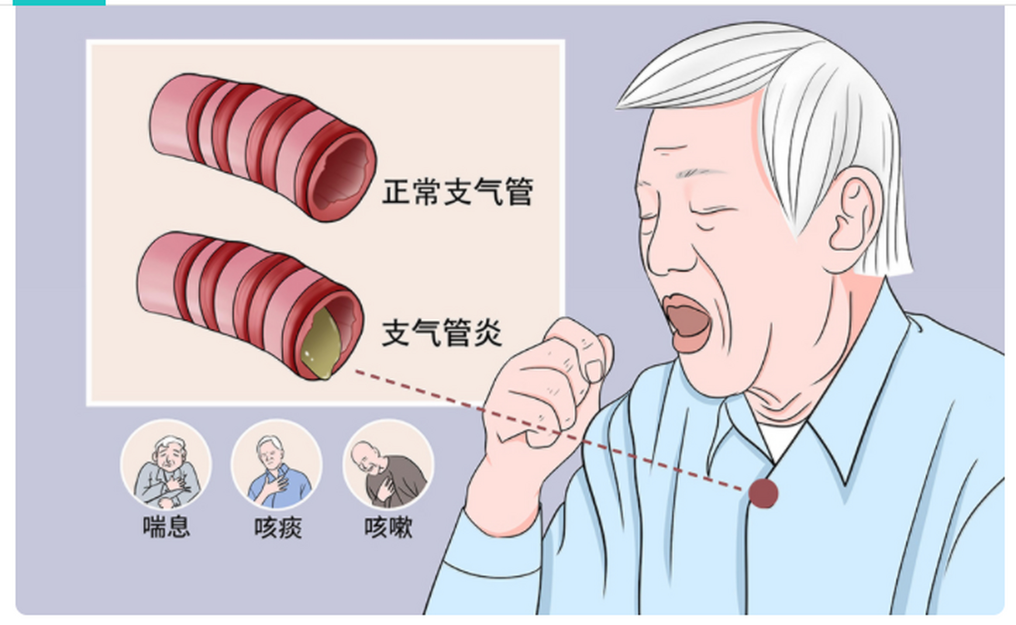 支氣管炎變好的三個過程，了解、治療和康復，支氣管炎康復之路，了解、治療與恢復三大階段