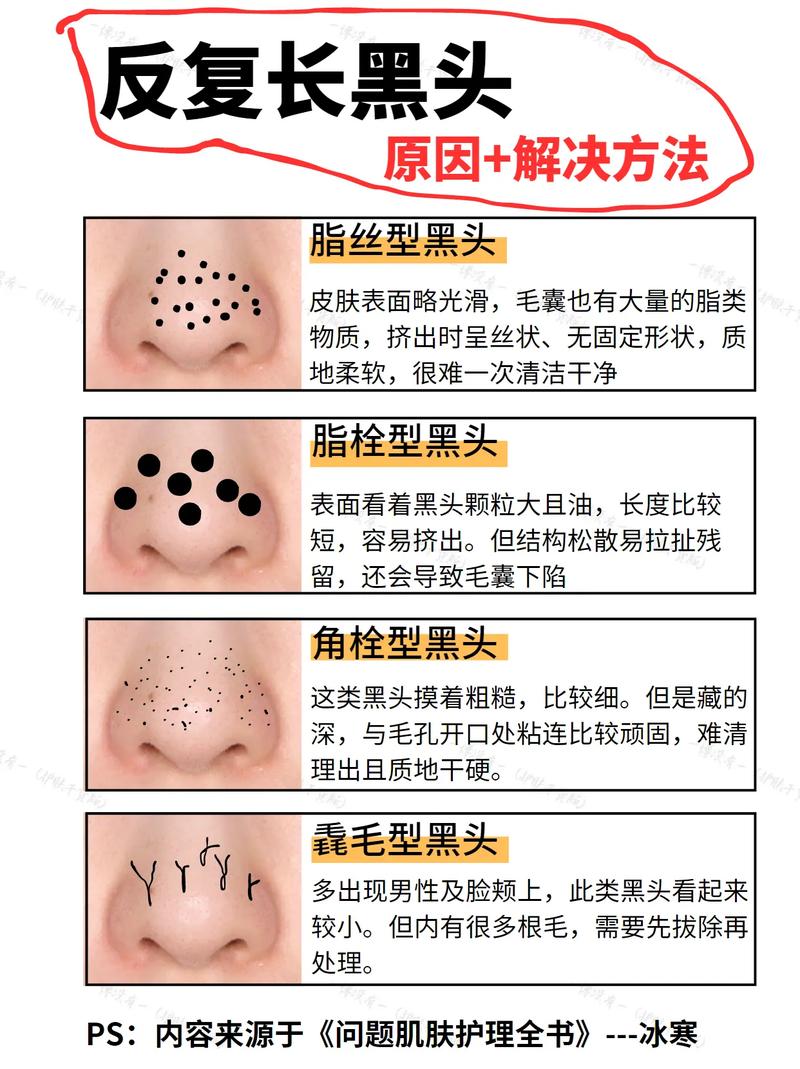 去黑頭最有效的方法，全面解析最佳去黑頭方案，全面解析，最有效的去黑頭方法與最佳方案選擇