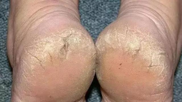 腳脫皮怎么辦？藥物治療的選擇與最佳用藥指南，腳脫皮怎么辦？藥物治療選擇與用藥指南