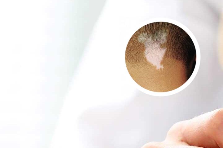 白點(diǎn)癲風(fēng)與白斑，深度解析兩者的區(qū)別及圖片對(duì)照，白點(diǎn)癲風(fēng)與白斑深度解析，區(qū)別與圖片對(duì)照指南