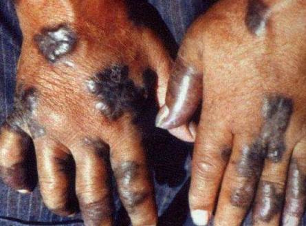 男人感染HIV的癥狀及應(yīng)對(duì)之策，男人感染HIV的癥狀與應(yīng)對(duì)策略