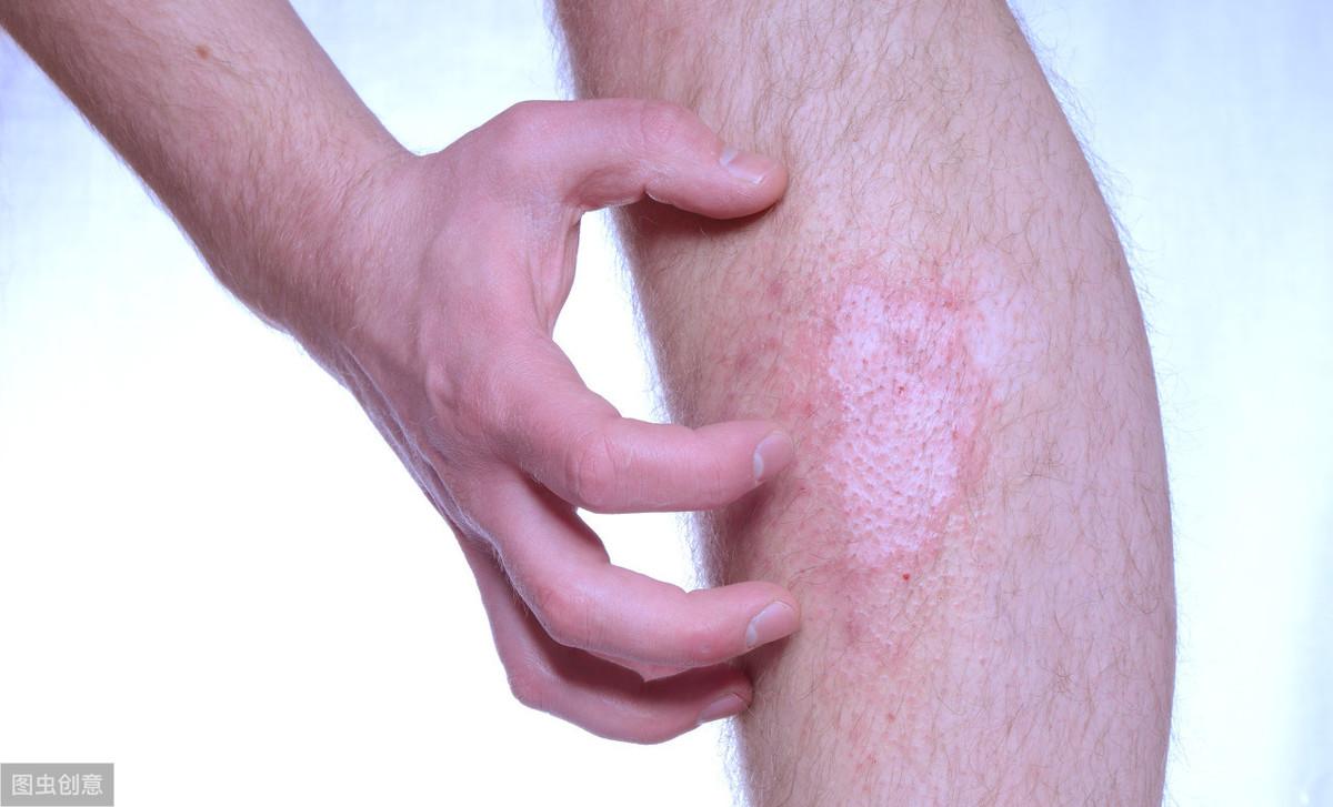 白斑初期癥狀圖片，識(shí)別與理解，白斑初期癥狀解析，圖片識(shí)別與理解指南