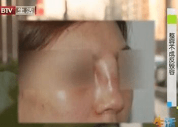 全面解析隆鼻手術(shù)價(jià)格一覽表，全面解析，隆鼻手術(shù)價(jià)格一覽表及費(fèi)用詳解