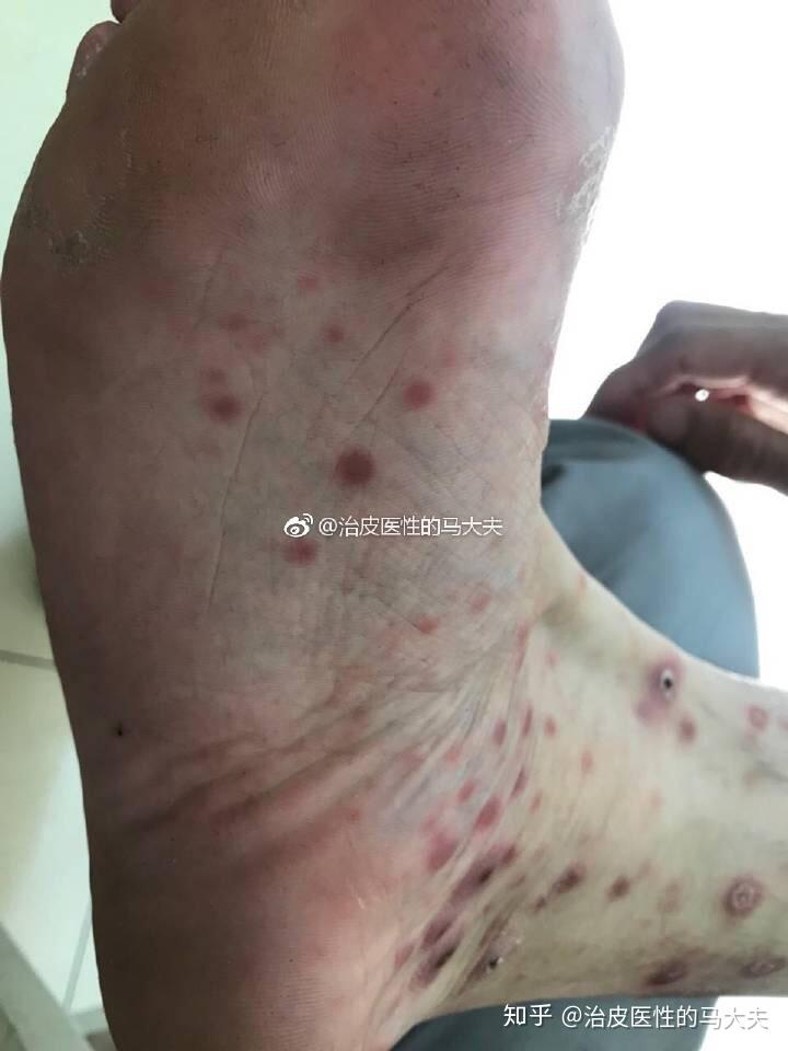 如何判斷自己是否感染了梅毒？，如何判斷自身是否感染梅毒？