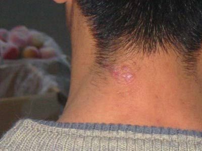 神經(jīng)性皮炎怎么除根，全面解析與應(yīng)對之道，神經(jīng)性皮炎全面解析，根治方法與應(yīng)對之道