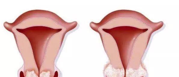 女性HPV真實(shí)圖片與早期癥狀解析，女性HPV真實(shí)圖片及早期癥狀深度解析