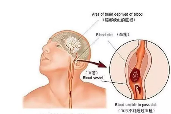 腦血栓前兆的六個表現(xiàn)及預(yù)防措施，腦血栓前兆六大表現(xiàn)與預(yù)防措施解析
