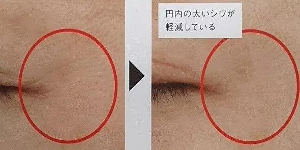 面部除皺針，價格因素詳解，面部除皺針價格因素全面解析