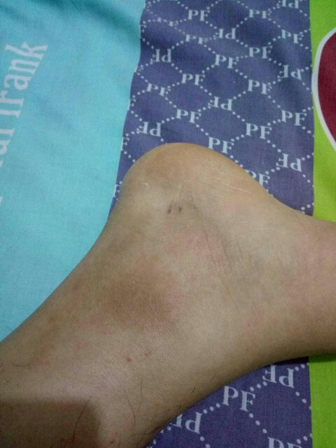 腳崴了腫了怎么快速消腫？，腳崴后快速消腫的方法與技巧