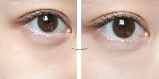 黑眼圈治療，快速有效的解決方案，黑眼圈治療，快速有效的解決方案探索