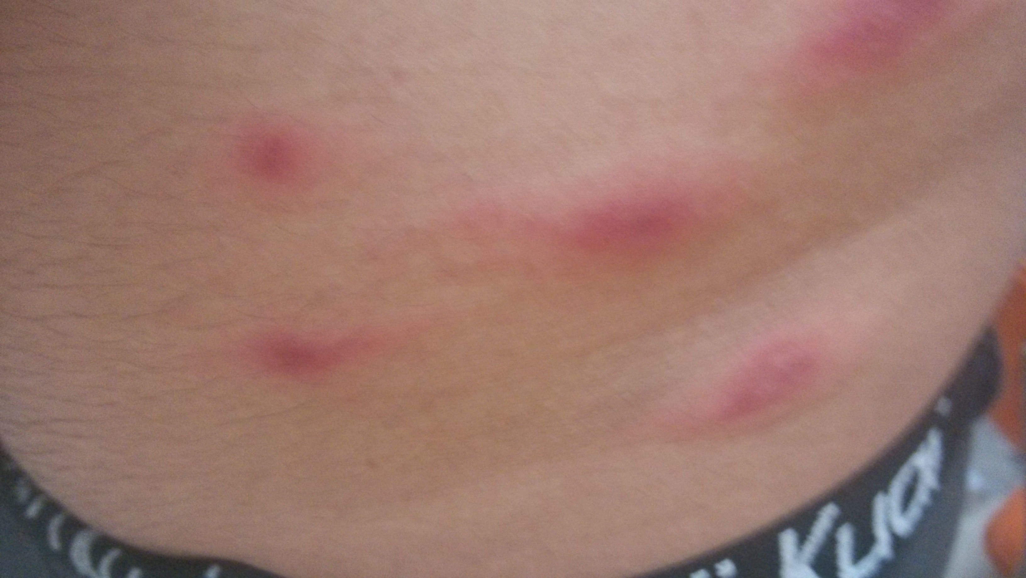 無緣無故長疙瘩又紅又癢，原因解析與應(yīng)對策略，無緣無故長紅癢疙瘩，原因解析及應(yīng)對方法