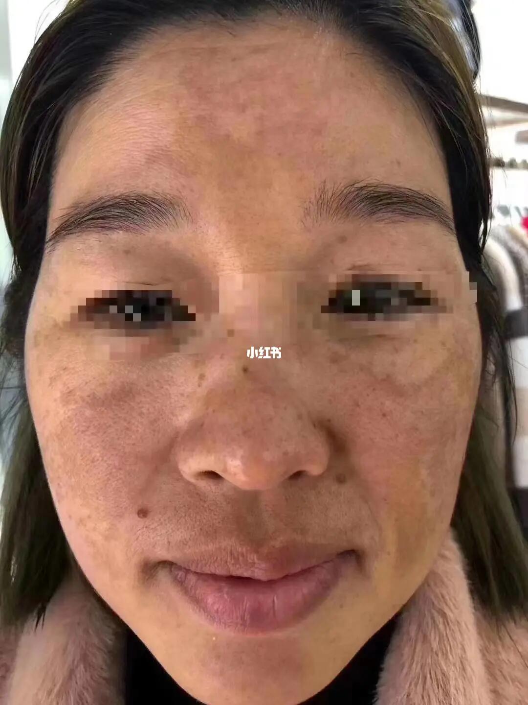 黃褐斑怎樣才能徹底去掉不反彈，黃褐斑徹底去除不反彈的方法與秘訣