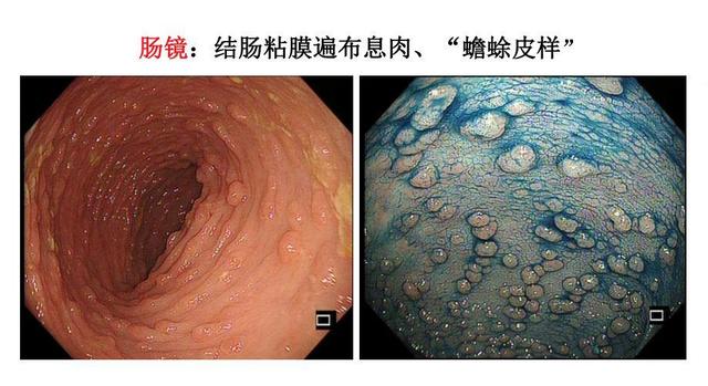 關于做腸鏡的十大壞處，你需要知道的事情，做腸鏡的十大潛在風險與副作用解析，你需要了解的事情