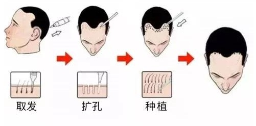 種植頭發(fā)的效果能保持多久，全面解析與指導建議，全面解析，種植頭發(fā)的效果持久性與指導建議