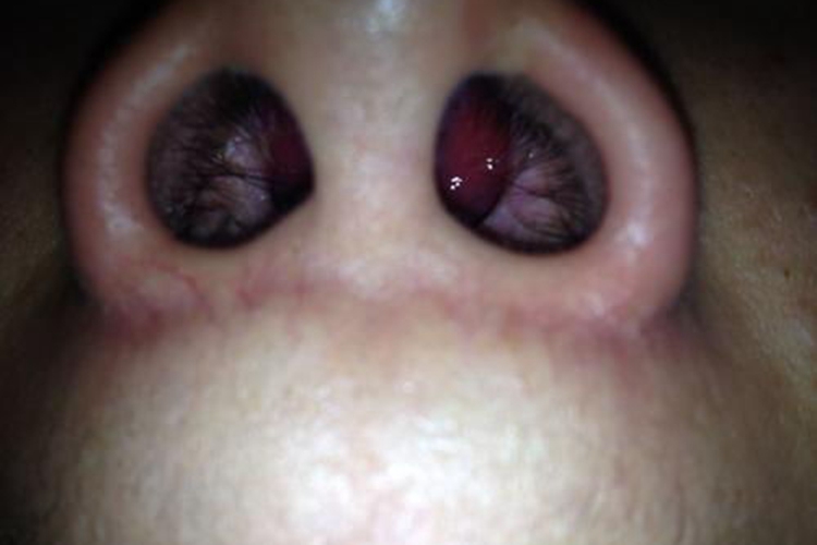 鼻息肉長什么樣子？圖片解析帶你深入了解鼻息肉的形態(tài)特征，鼻息肉的形態(tài)特征解析，圖片帶你深入了解鼻息肉長什么樣？