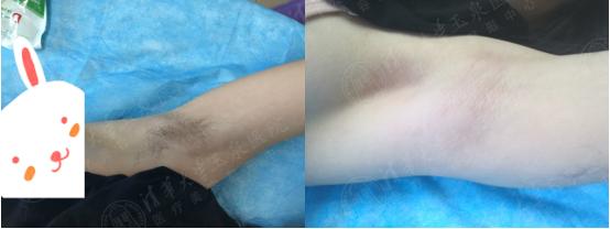 激光脫毛一次大概需要多少錢，全面了解脫毛費(fèi)用及注意事項(xiàng)，激光脫毛費(fèi)用詳解，脫毛費(fèi)用與注意事項(xiàng)全解析