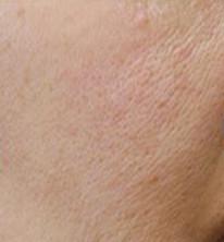 毛孔粗大能修復(fù)嗎？全面解析毛孔問(wèn)題及其解決方案，毛孔粗大全面解析與修復(fù)方案，解決毛孔問(wèn)題，重塑肌膚細(xì)膩之美