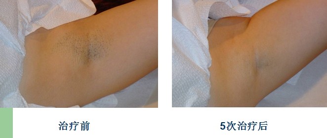 激光脫毛價格解析，多少錢才能擁有光滑肌膚？，激光脫毛價格詳解，擁有光滑肌膚需花費(fèi)多少？