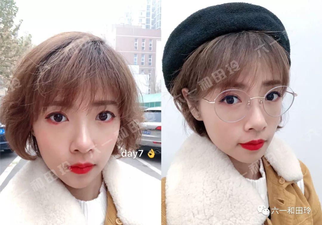 無(wú)痕去眼袋手術(shù)全過(guò)程詳解，無(wú)痕去眼袋手術(shù)全程詳解揭秘