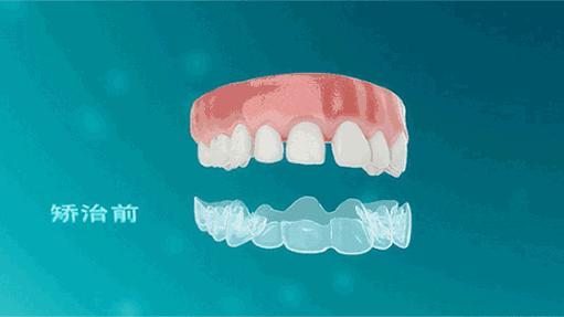 牙齒正畸費(fèi)用詳解，一般多少？，牙齒正畸費(fèi)用全面解析，了解一般價格及影響因素