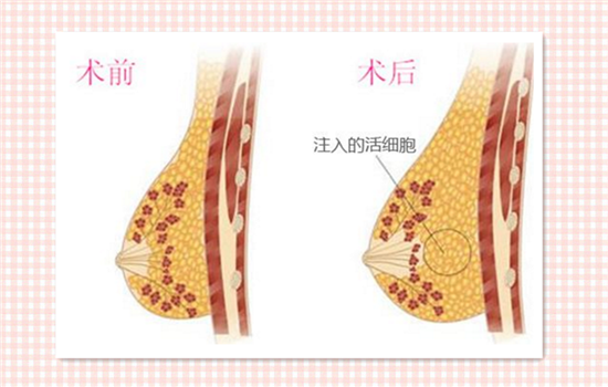 自體脂肪隆胸的真實經(jīng)歷分享，自體脂肪隆胸的真實體驗分享