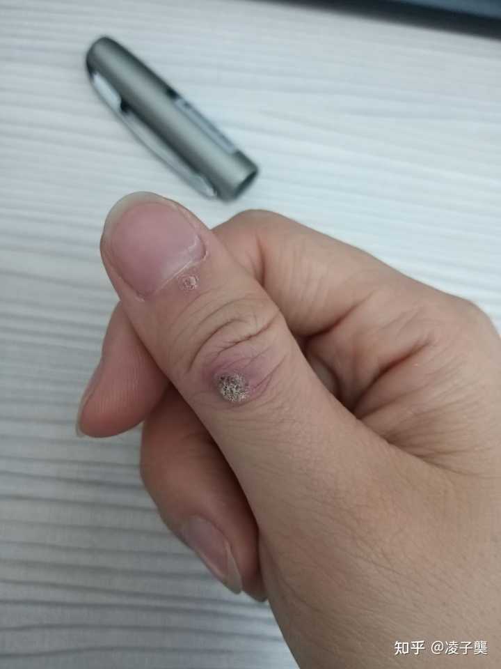 瘊子怎么去除最好方法，全面解析有效手段，瘊子去除的最佳方法，全面解析有效手段