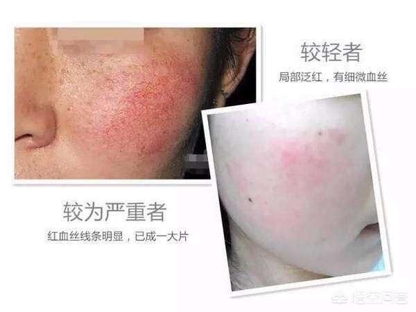 消除紅血絲臉上小妙招，消除紅血絲的面部護(hù)理小妙招