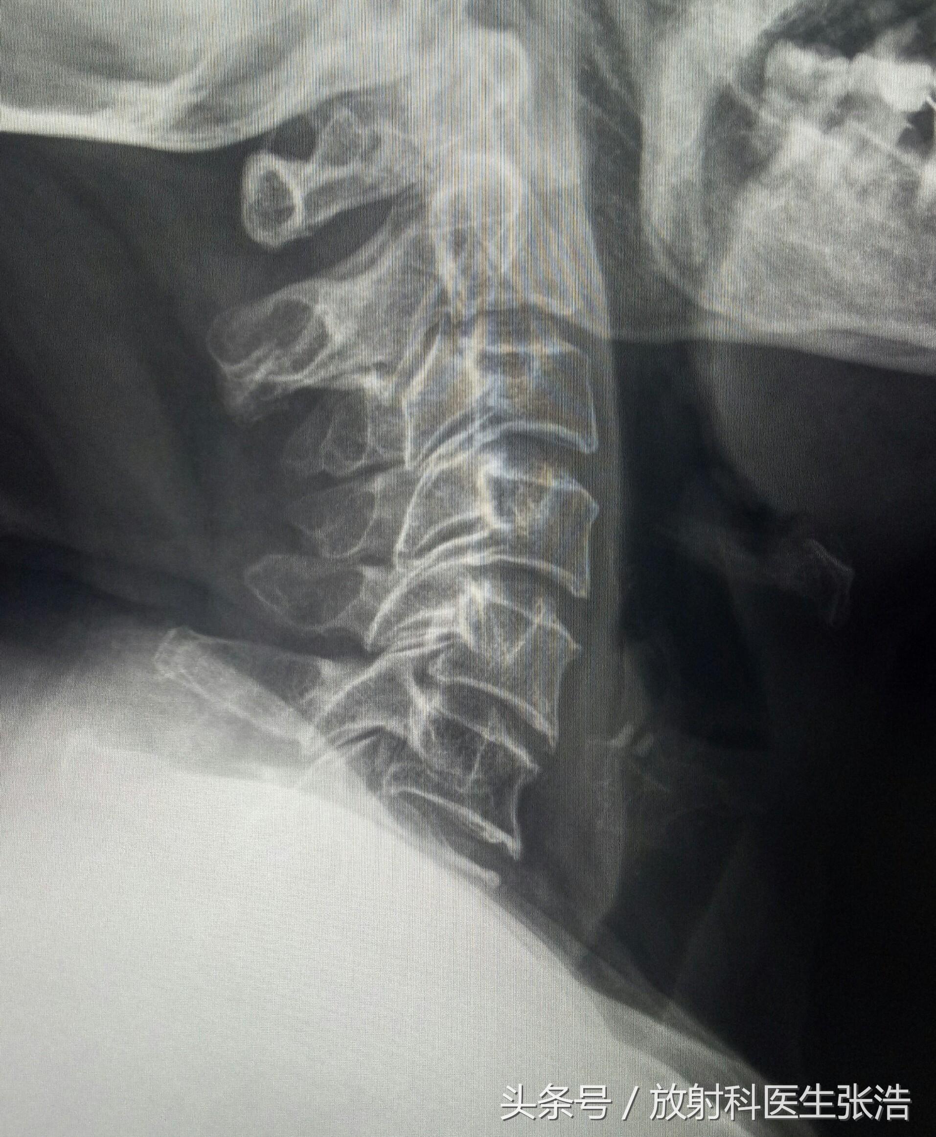 關(guān)于骨質(zhì)增生的十大特效藥，你需要知道的信息，關(guān)于骨質(zhì)增生的十大特效藥，必備知識科普