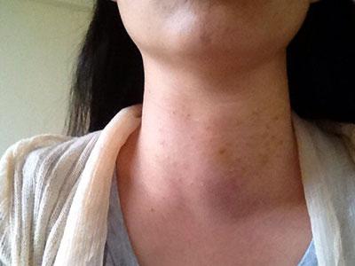 甲狀腺癥狀詳解，了解甲狀腺疾病的表現(xiàn)與征兆，甲狀腺疾病癥狀詳解，表現(xiàn)與征兆全面解析