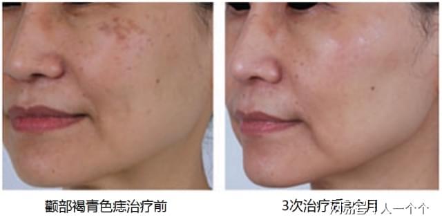 激光祛斑后需要注意的五大事項(xiàng)，激光祛斑后的五大注意事項(xiàng)詳解