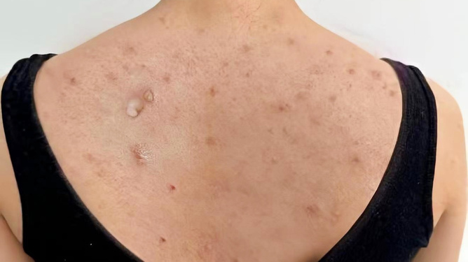 螨蟲怎么去除最有效的方法，有效去除螨蟲的方法大全