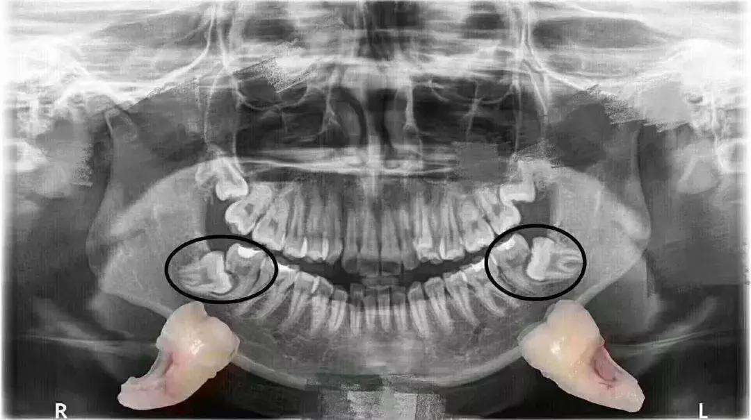 智齒的形態(tài)與圖片解析，了解智齒的真實(shí)面貌，智齒形態(tài)解析，揭示智齒真實(shí)面貌與圖片詳解