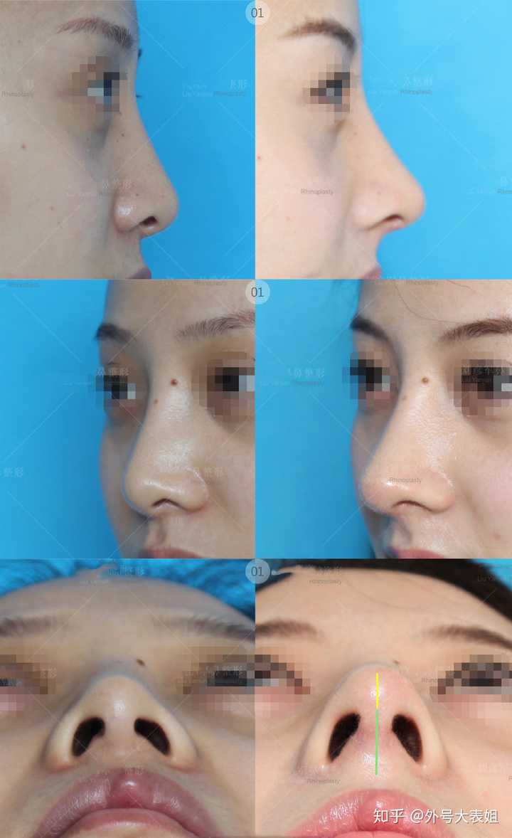 如何有效進(jìn)行縮鼻頭——專(zhuān)業(yè)指南與實(shí)用建議，專(zhuān)業(yè)指南與實(shí)用建議，有效縮鼻頭的方法