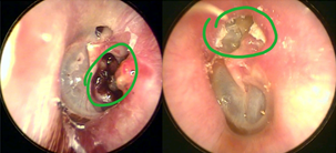 中耳炎是怎么引起的，中耳炎的成因解析