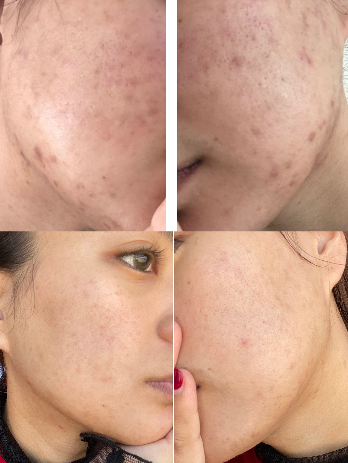 淡化痘印，護(hù)膚秘籍與實(shí)用建議，淡化痘印，護(hù)膚秘籍助你重拾肌膚光彩