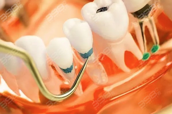 牙齒根管治療費用詳解，一般多少錢一顆？，牙齒根管治療費用全面解析，根管治療一顆牙齒的價格是多少？