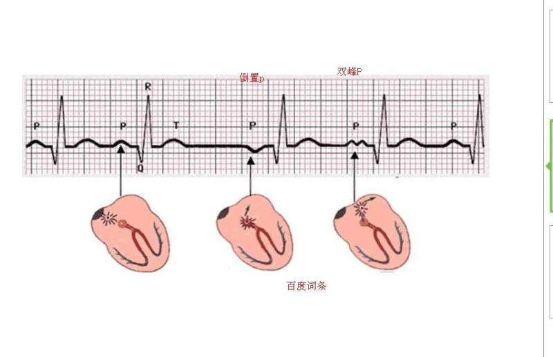 竇性心律不齊嚴(yán)重嗎？解讀與應(yīng)對之道，解讀與應(yīng)對之道，竇性心律不齊的嚴(yán)重性及其影響