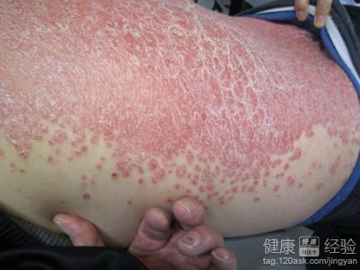 魚鱗皮膚病如何才能根治——全面解析與應(yīng)對策略，魚鱗皮膚病全面解析，根治方法與應(yīng)對策略