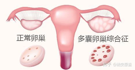 多囊卵巢綜合癥的三個重要診斷標準，多囊卵巢綜合癥的三大診斷標準解析