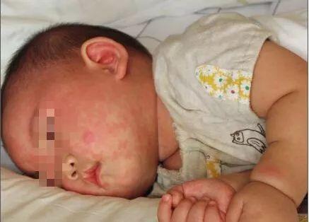 關(guān)于怎樣的紅斑是梅毒的探討，梅毒紅斑特征解析，如何識(shí)別梅毒引發(fā)的皮膚紅斑