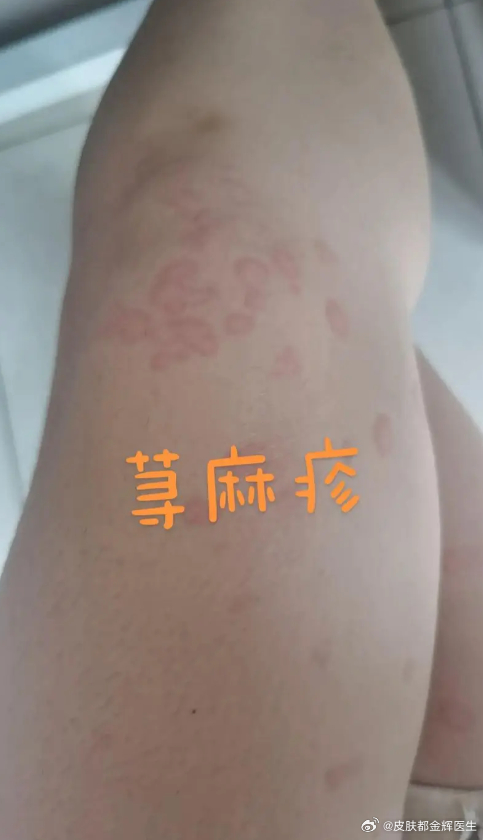 關(guān)于一支1400元的蕁麻疹針的名稱及詳細信息，關(guān)于蕁麻疹治療針（價值1400元）的名稱及詳細信息探討