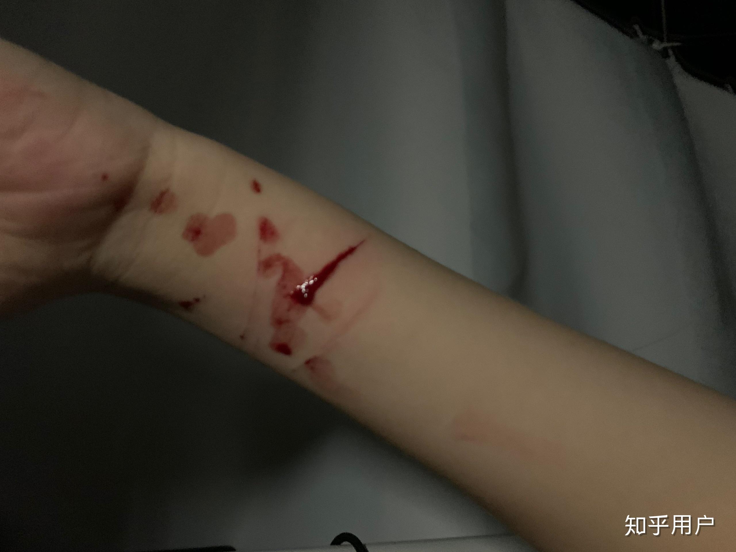 探究出現(xiàn)自殘行為是幾度抑郁，探究自殘行為與抑郁程度的關系